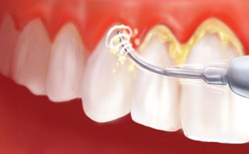 Limpieza dental. odontologo otumba