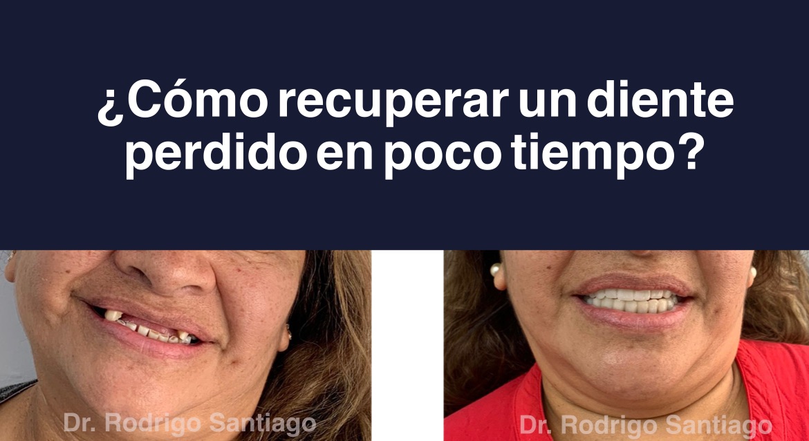 Recuperar un diente perdido rapido, poco tiempo, con Dr. Rodrigo Santiago.