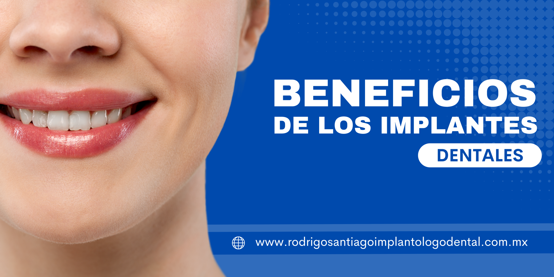 Beneficios de los implantes dentales